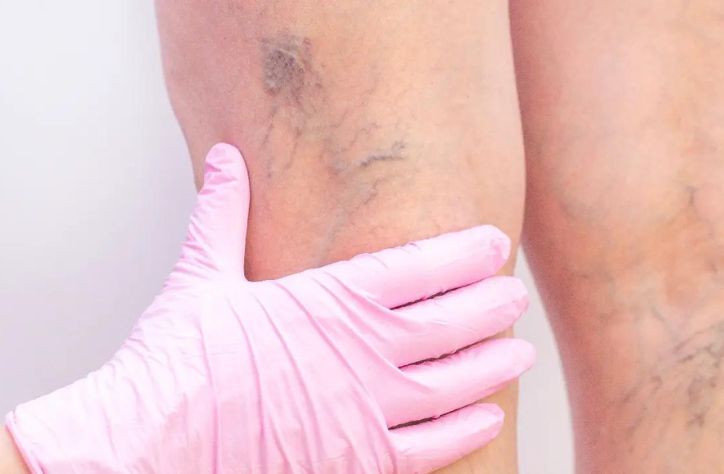 When To Worry About Varicose Veins