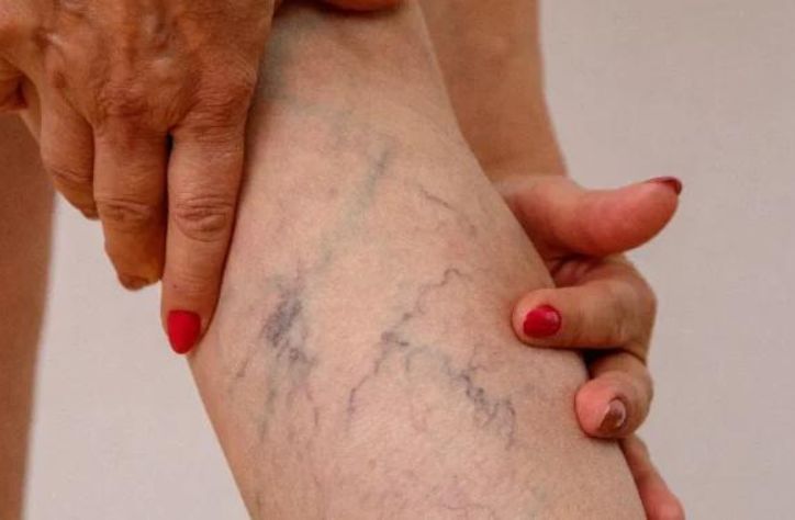 our Ultimate Guide to Varicose Vein Self-Care