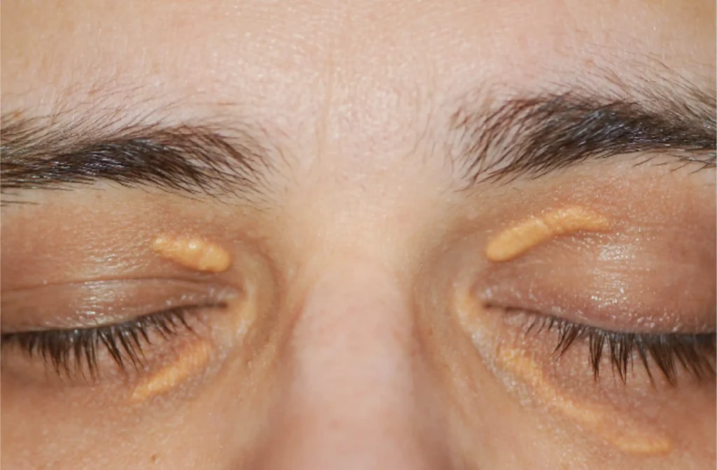 Xanthelasma (Yellowish Patches Around the Eyes)