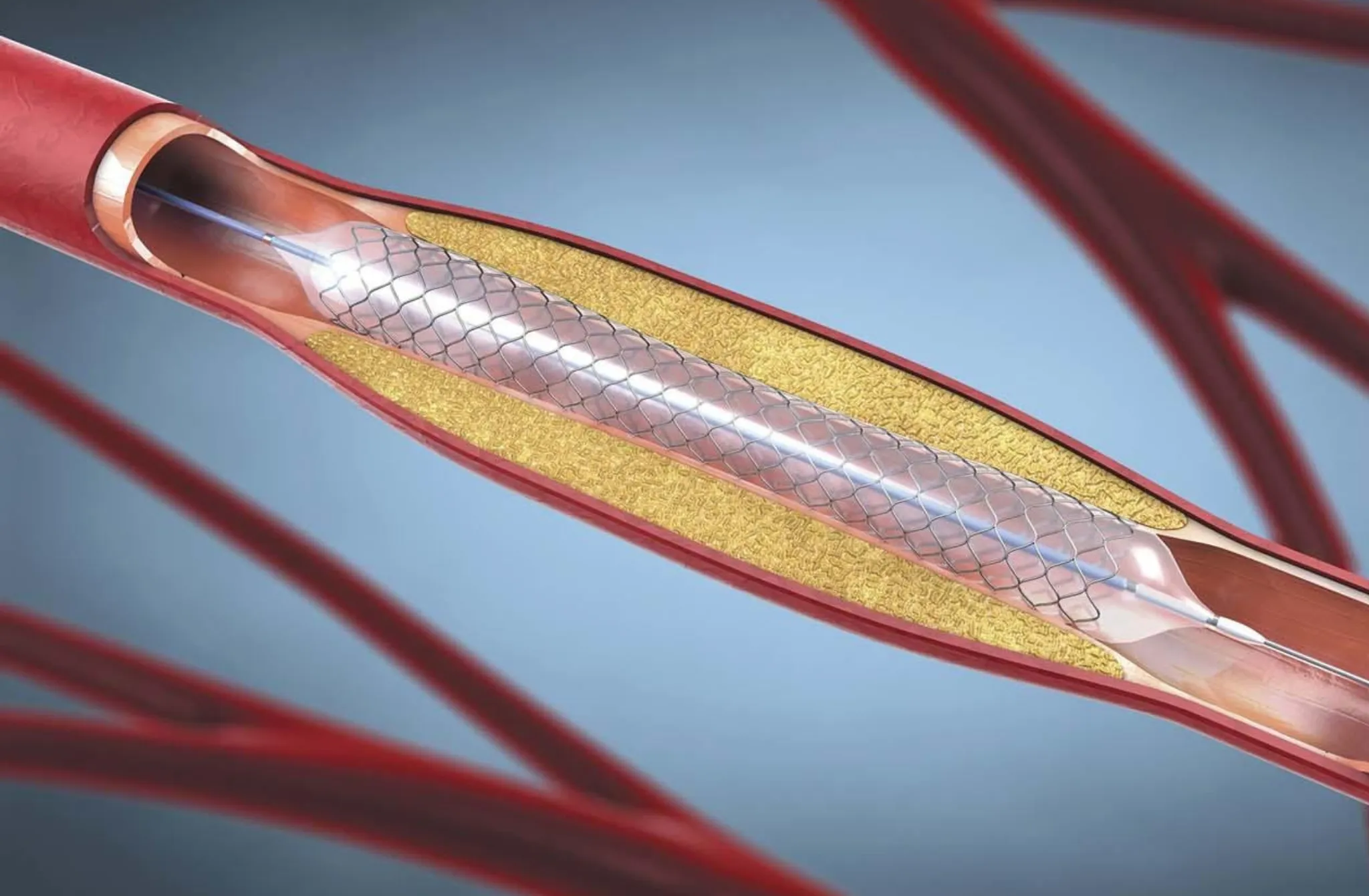 Is Angioplasty and Stent the Same Guide on Their Differences, Benefits, Risks, and Recovery