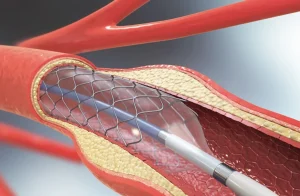 What to expect after angioplasty and stent
