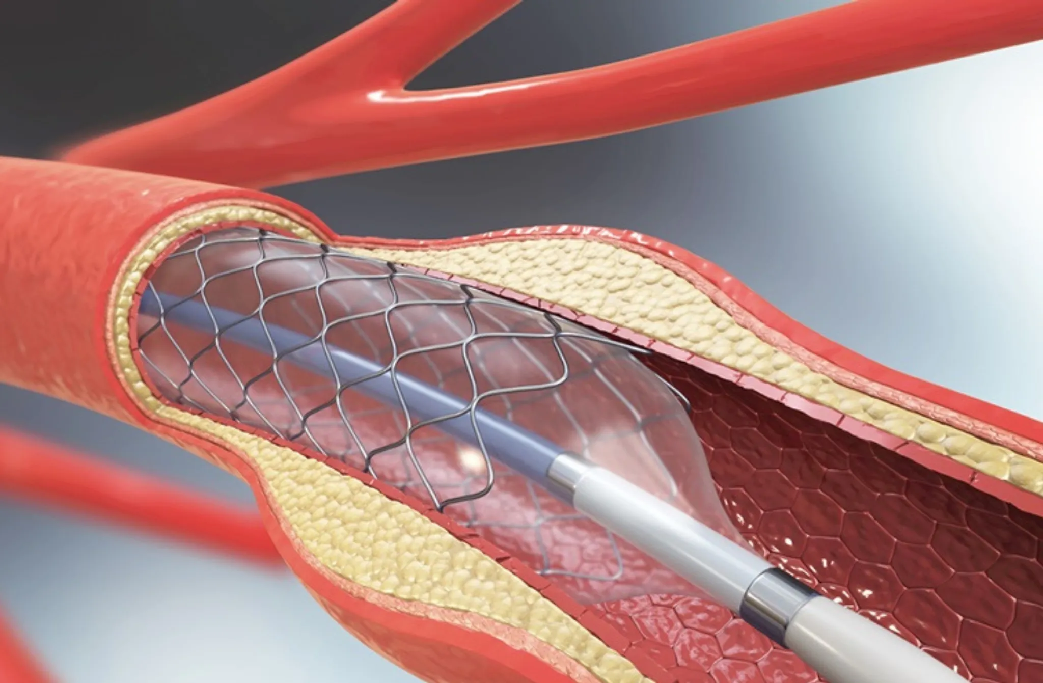 What to expect after angioplasty and stent