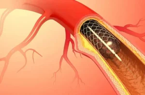 is a heart catheterization dangerous