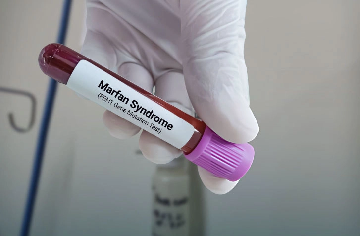 Is Marfan Syndrome a Disability?