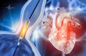 Balloon Valvuloplasty