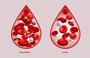 Can Anemia Cause Heart Palpitations