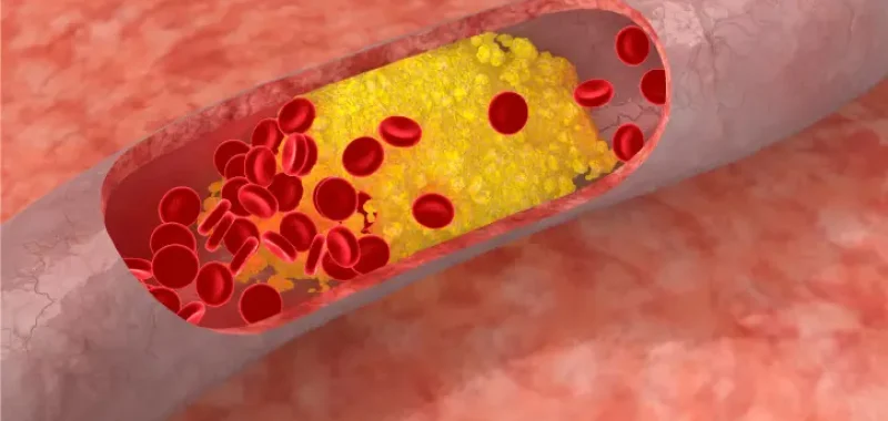 How Many Americans Have High Cholesterol